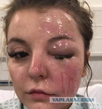 Вот и позавтракала... Девушка ослепла на один глаз, сварив яйца в микроволновке