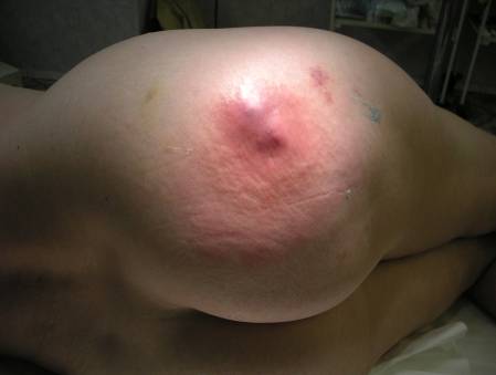 Антибиотики и маркетинг как угроза здоровью