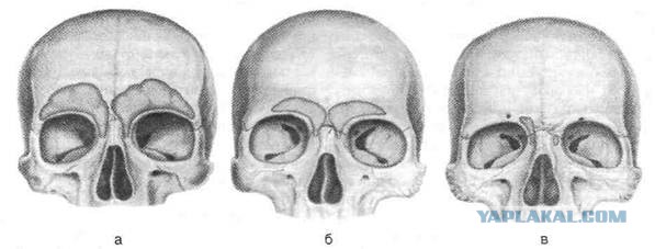 отсутствие лобных пазух