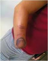 Тату вместо глаза, на месте укуса паука