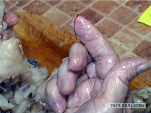 Любитель суши из Китая заразился червями из сашими