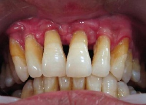 Стоматолог ради выгоды удалила пациентке 22 здоровых зуба