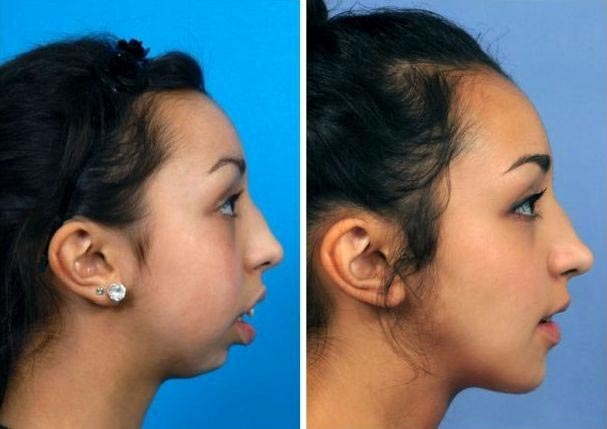 Невероятное преображение девушки после пластической коррекции челюсти
