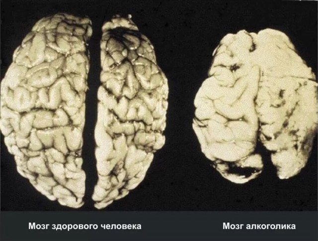 Исследование: алкоголь долго разрушает мозг даже после отказа от него