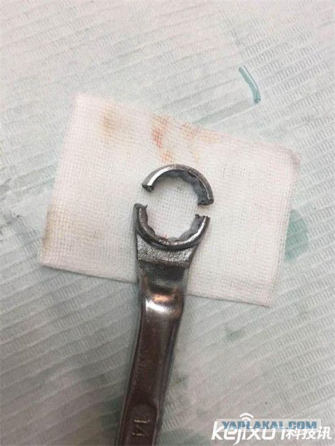 Стоматологи освободили пенис мужчины застрявший в гаечном ключе