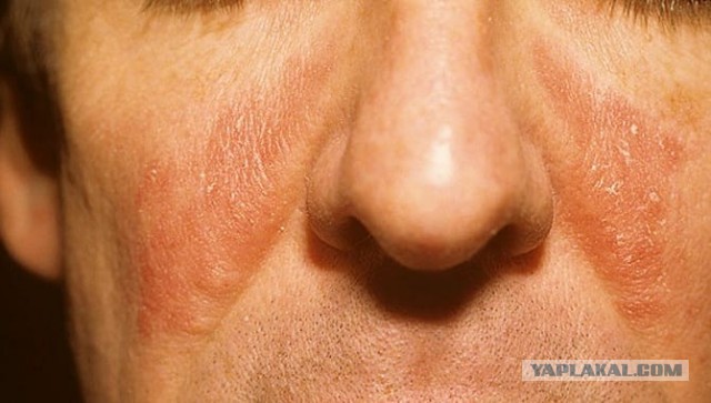 Про себорею, дерматит, и вообще кожные заболевания