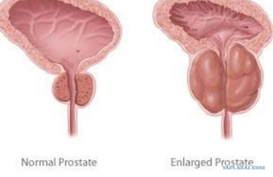 Увеличенная простата лечение