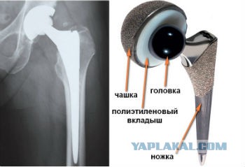 Протез тазобедренного сустава