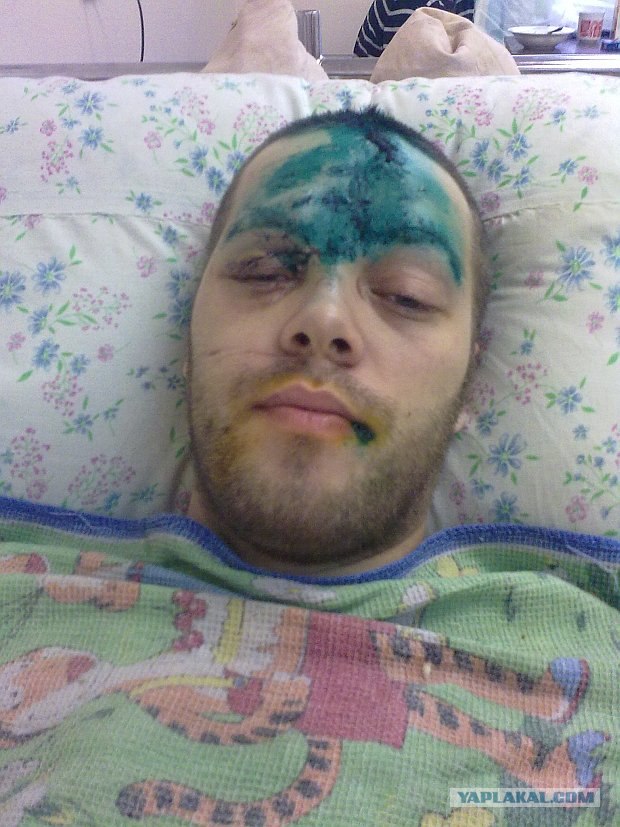 Пьяный водитель сделал меня инвалидом