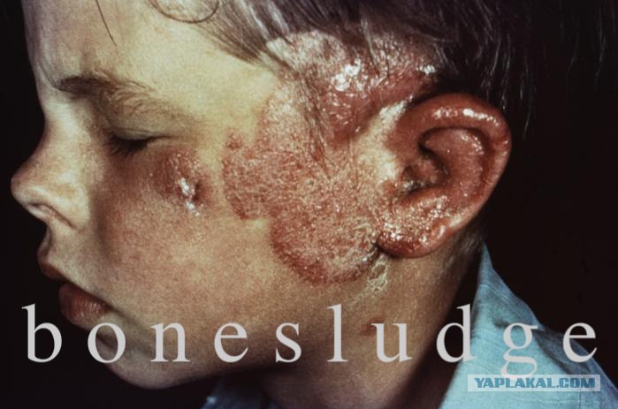 Острая лучевая болезнь видео