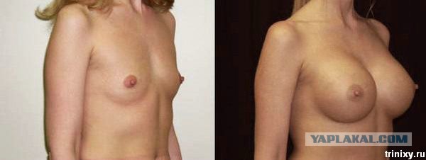 Некоторым девушкам силиконовая грудь просто