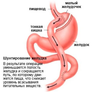 Чтобы не умереть от лишнего веса, американец скинул 160 кг