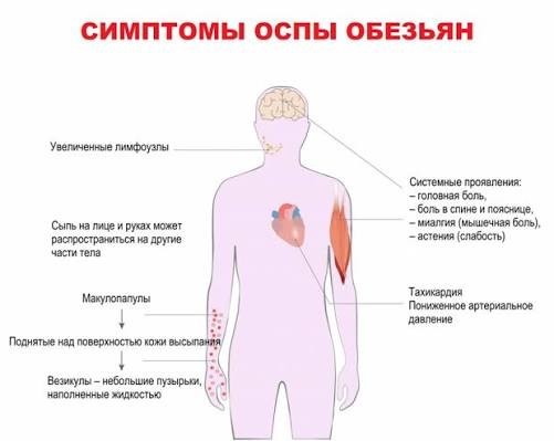 5 человек госпитализированы с подозрением на оспу обезьян в Санкт-Петербурге