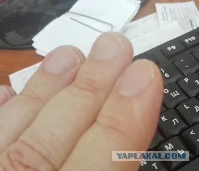 Шрамы на пальце - есть у всех? У меня даже два!