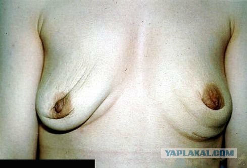 Польза массажа груди