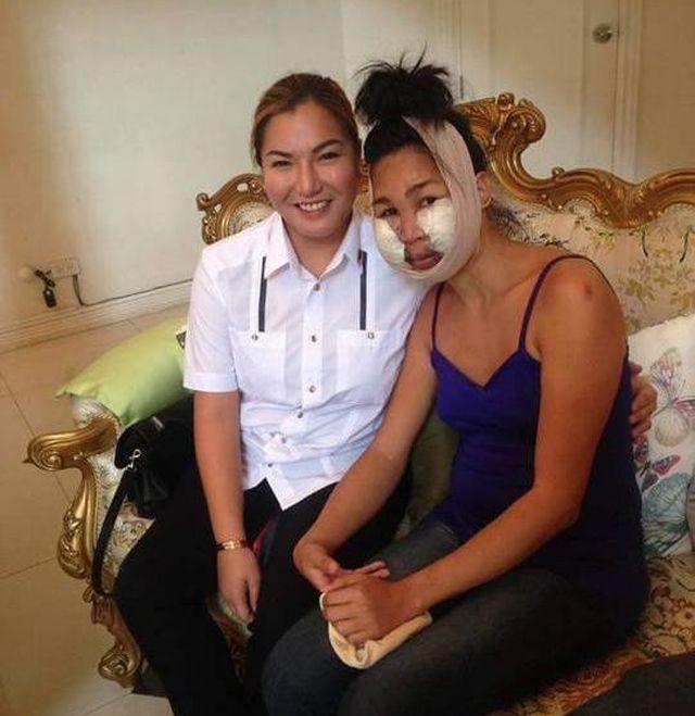 Подружки не выходят из дома после того, как косметолог-самоучка накачала их лица вазелином