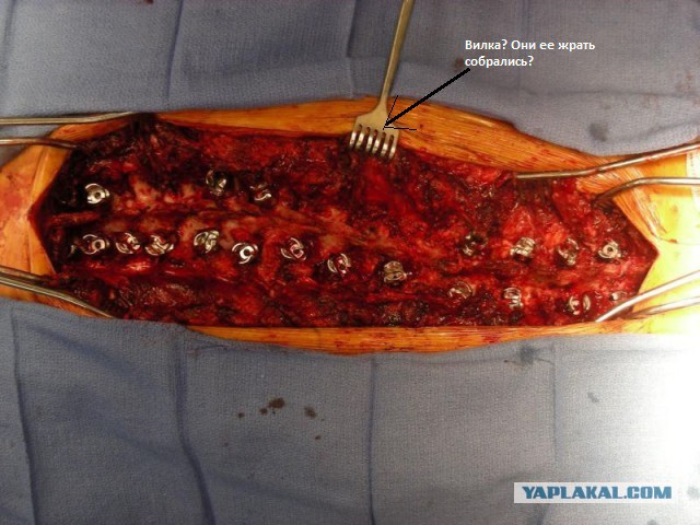 Сильная девушка до, во время и после операции на позвоночнике