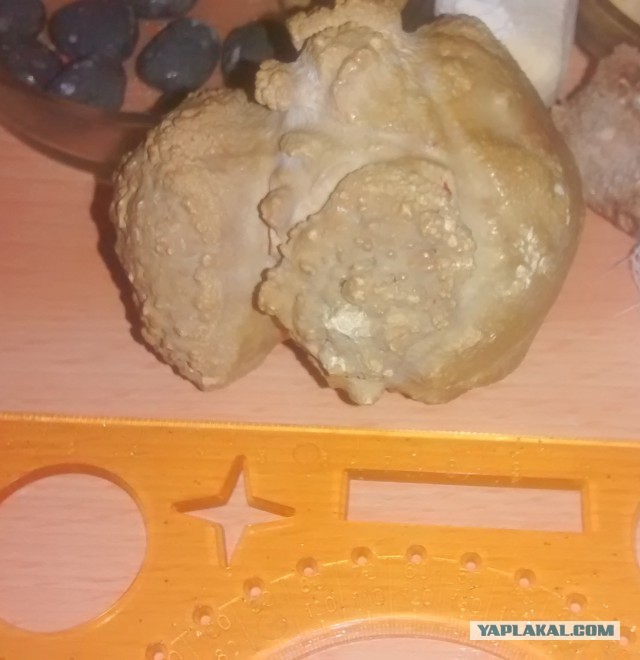 Камни в почках...
