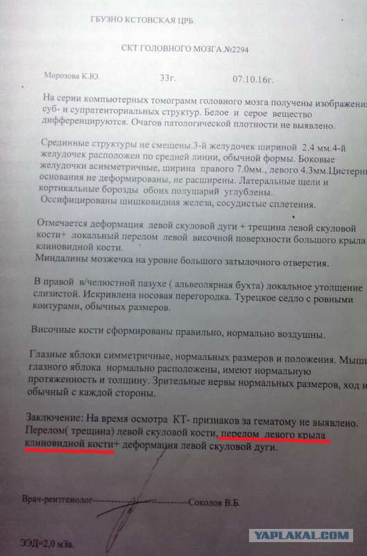 Суд назначил 5 000 рублей компенсации девушке, которой в полиции проломили кости лица