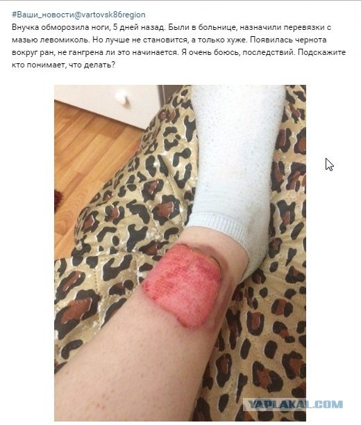 Щиколотные зайцы