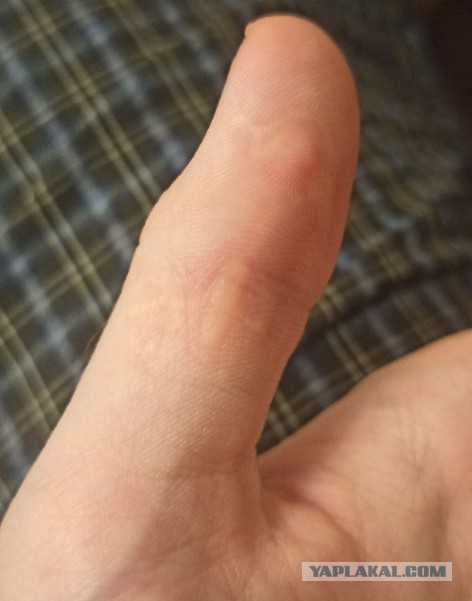 К чему снится оторванный палец. Оторванный палец в пакете. Оторвался ноготь с корнем. К чему снится оторванный палец. К чему снится оторванный палец.