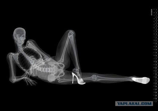 Рентген человека весом в 410 кг
