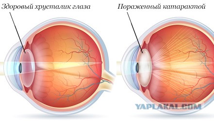 Что ищут офтальмологи у пациентов с катарактой?