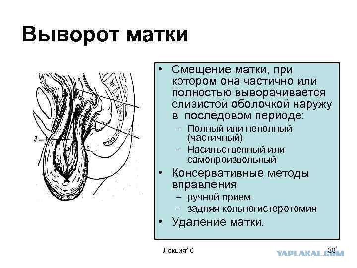 Выворот матки презентация