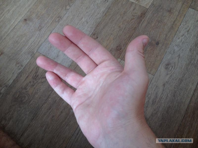 Сколько срастается палец на руке