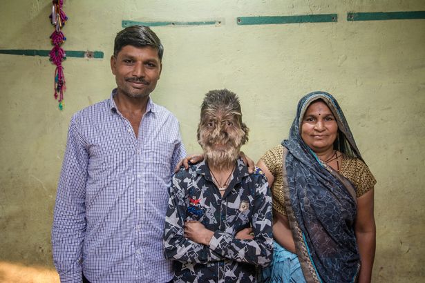 Добрый и пушистый: 13-летний мальчик из Индии страдает «синдромом оборотня»