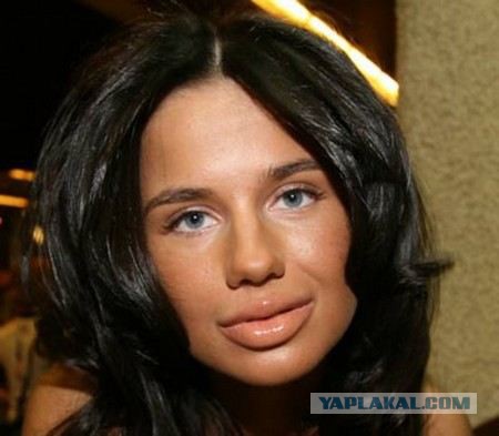 Выпускница «Фабрики звезд» — Алекса (до и после пластической хирургии)