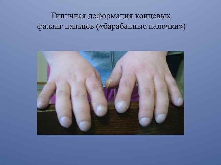 барабанные палочки этиология. симптом барабанных палочек. пальцы ног в виде барабанных палочек. синдром барабанных палочек пальцы. симптом барабанных палочек и часовых стекол.