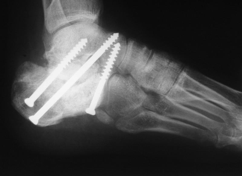 Открытый перелом кости руки. Пяточная кость рентген перелом. Перелом пяточной кости остеосинтез. Накостный остеосинтез голени рентген. Перелом пяточной кости рентген.