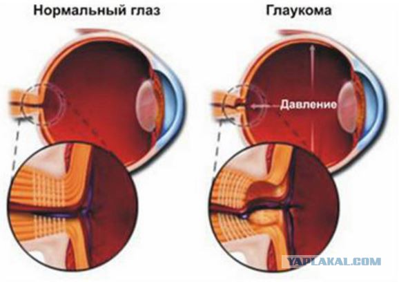 Что ищут офтальмологи при измерении внутриглазного давления?