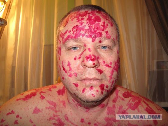 Советы взрослым людям, заболевшим ветрянкой