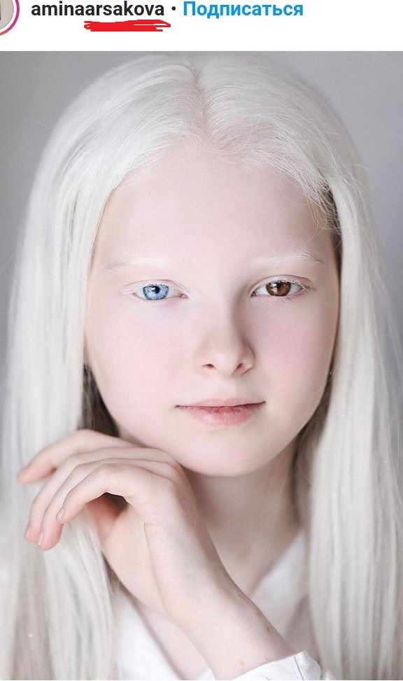 Чеченская девочка - альбинос
