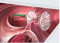 Инсульт: взгляд изнутри
