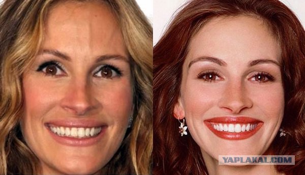 10 знаменитостей до и после реставрации зубов