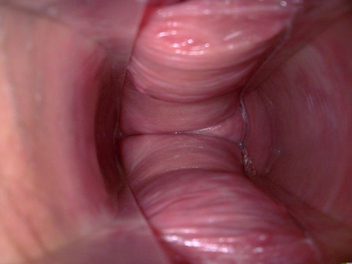 Lump On Vagina