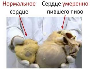 Пивной алкоголизм