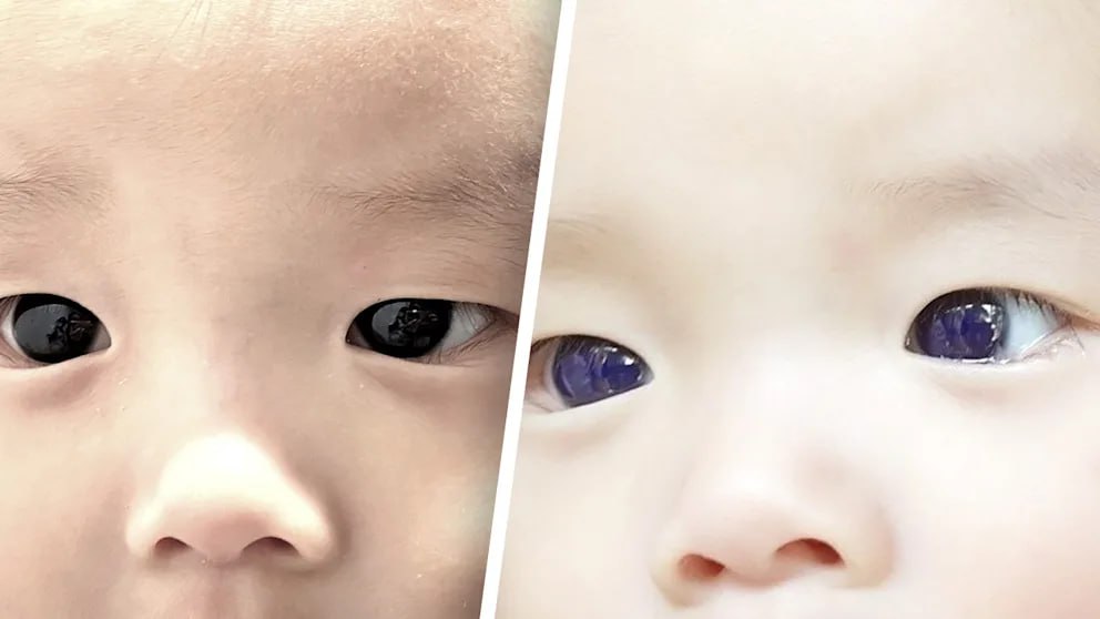 Влияние химии: в Таиланде после японского лекарства от коронавируса у  младенца изменился цвет глаз - ЯПлакалъ