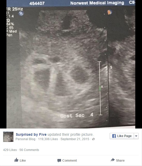 Как это выглядит, если вы беременны пятерняшками.