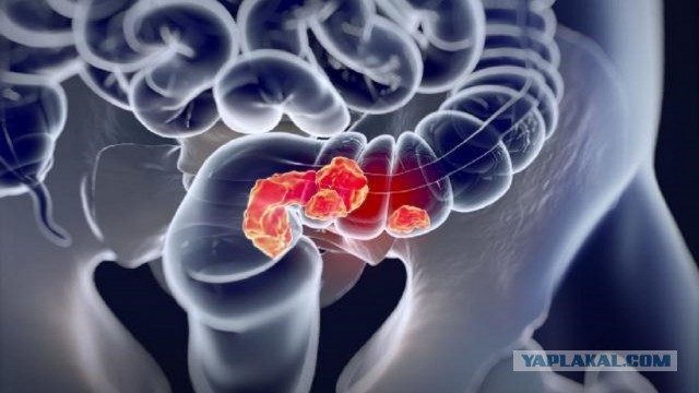 Новый препарат перевел рак в ремиссию у 100% пациентов