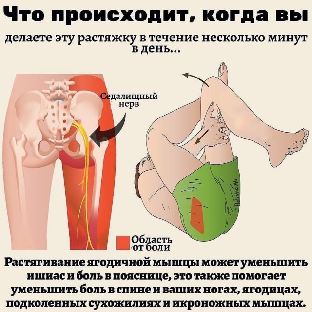 Как лечить защемление седалищного нерва?