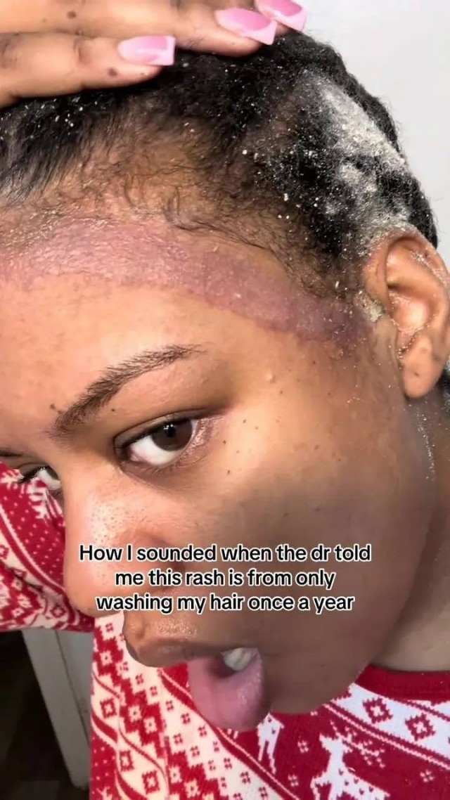 Американка не мыла голову год и нашла моль