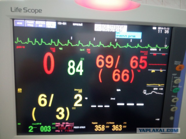 Искусственное кровообращение