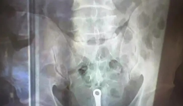 Уфимец не смог объяснить врачам «скорой», как ершик попал в его задний проход