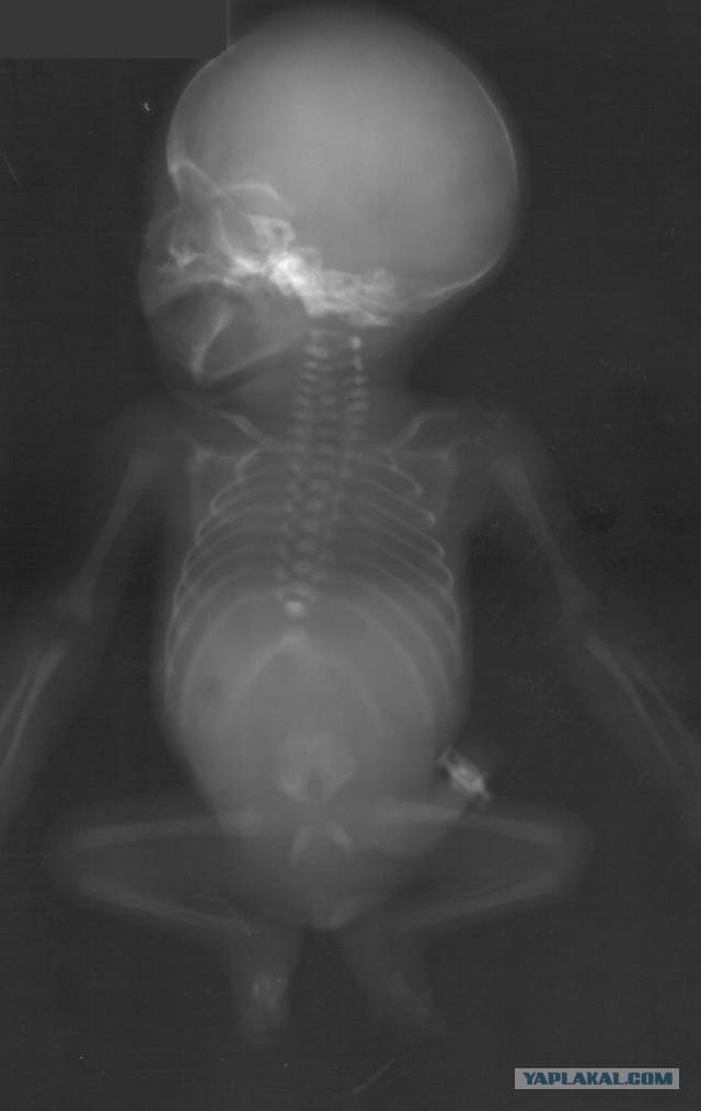 Самый быстрый человек на двух руках