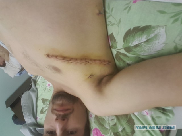 Писал я тут про свой недуг...