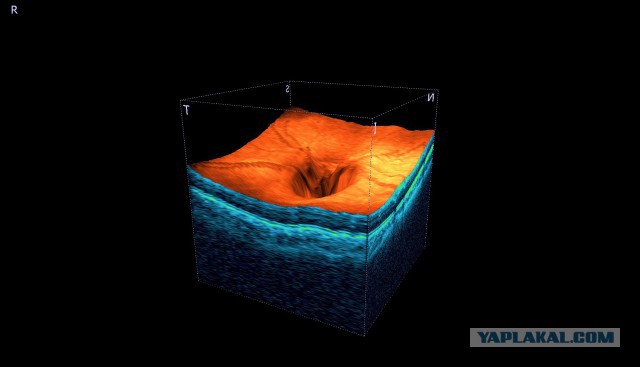 Что ищут офтальмологи на глазном дне?